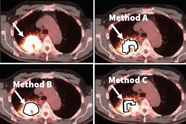 Which method to choose to delineate the tumor? In this example application, Jha’s task is to find the metabolic tumor volume from a clinical PET image (top left). The photos in the top right and bottom row show that different segmentation methods to measure this volume give different results, demonstrating the need for no-gold-standard evaluation to find the optimal method. (Jha lab)}