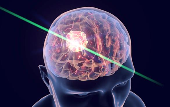 Using lasers to burn away a recurrent brain tumor can add an average of two months to a patient’s life compared with chemotherapy, the standard treatment for a tumor that has returned, according to a new study from Washington University School of Medicine