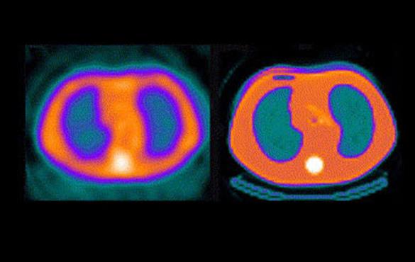 Abhinav Jha and collaborators will develop methods to model the physics that lead to scattered photons in cardiac imaging to estimate the attenuation map, as seen in this image from Seminars in Nuclear Medicine, October 2006.
